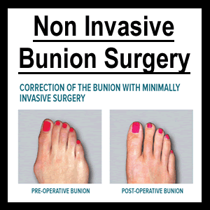 non invasive bunion surgery 1