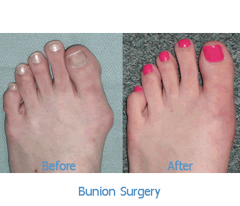 non invasive bunion surgery before and after